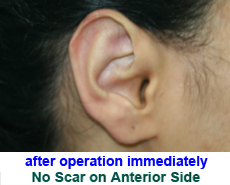 plastic-surgery-prominent-ear 